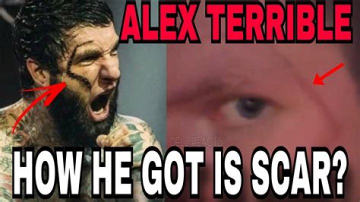 Alex Terrible’s Scar: Fake, Real, Or Makeup?